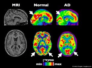 Alzheimers Disease includes reduced brain activity and function (red areas above), the result of years of accumulated damage. Molecules in pot seem to prevent this damage.
